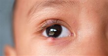 Việc cần làm khi bị bệnh chắp lẹo mắt